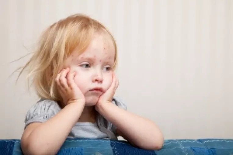 Rujeola poate provoca o amnezie partiala a sistemului imun